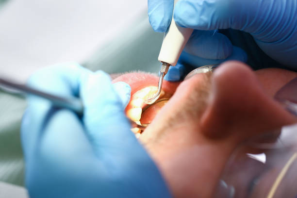 Best Emergency Dental Extractions in Beverly, MA